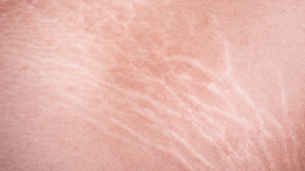 Ilustrasi Stretch Mark