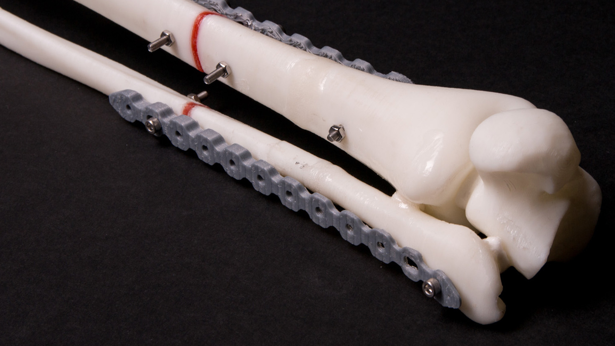 Model of a Bone Stabilizer